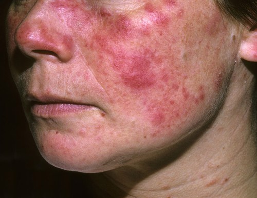 Lupus ban đỏ hệ thống biến chứng thận điều trị như thế nào? TÌM HIỂU NGAY!